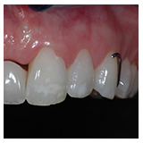 Transitional restorations at Implant sites